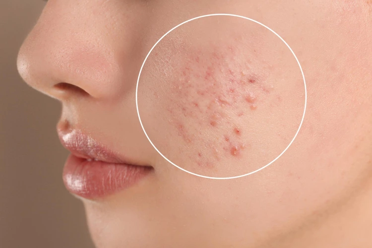 Lady suffering from acne scars on her face.