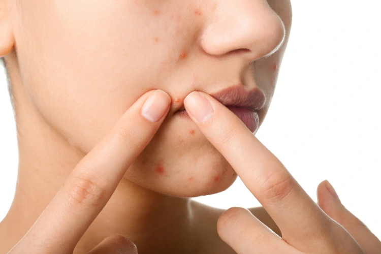 Lady pointing and indication the presence of acne on her upper lip and chin area.