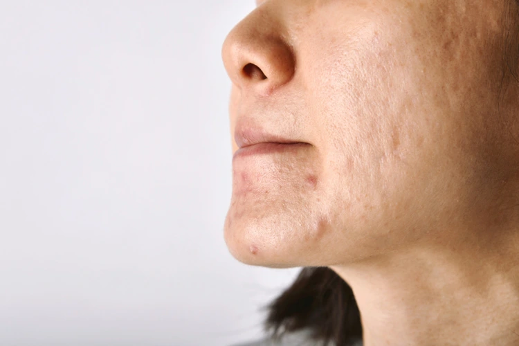 Lady with acne on her cheeks and chin area.