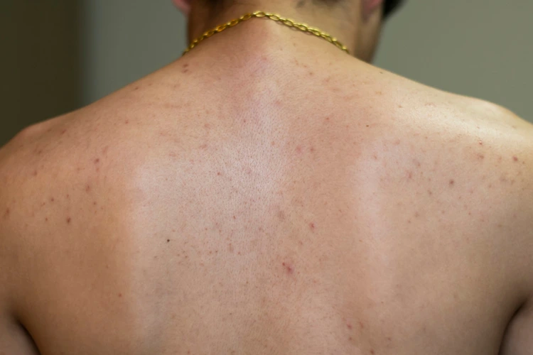 Back of a man with acne and acne scars.
