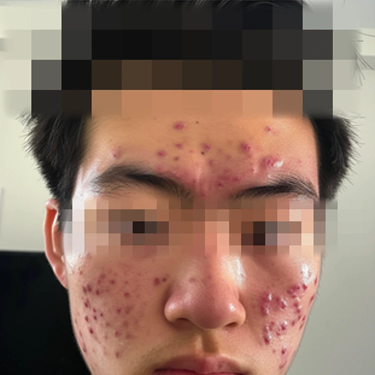 Man with severe case of cystic acne on his face.