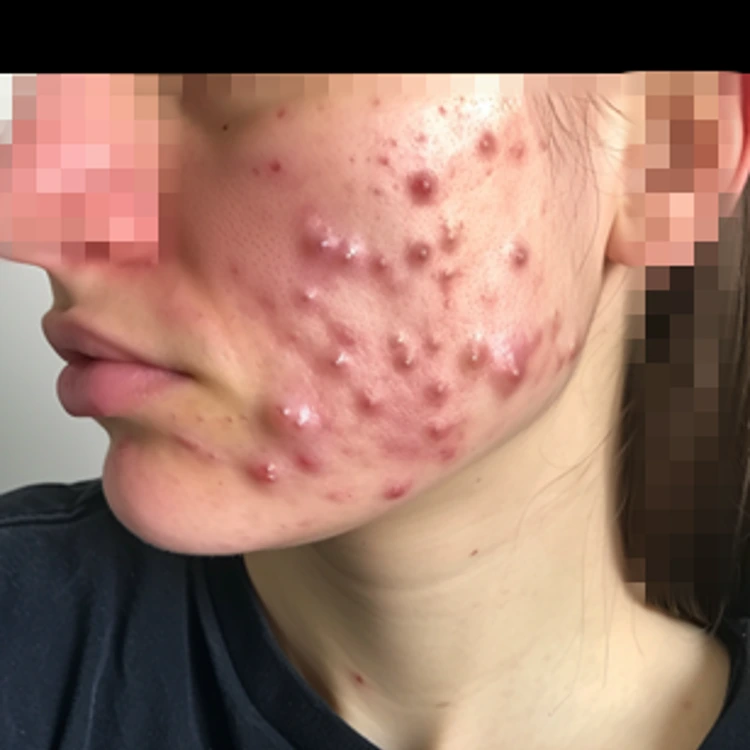 Woman with severe case of cystic acne on her face.