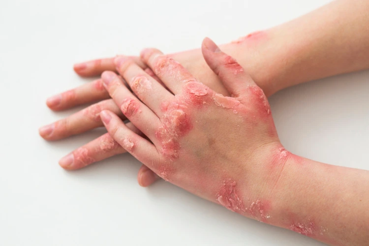 Person having severe eczema condition on both both hands.