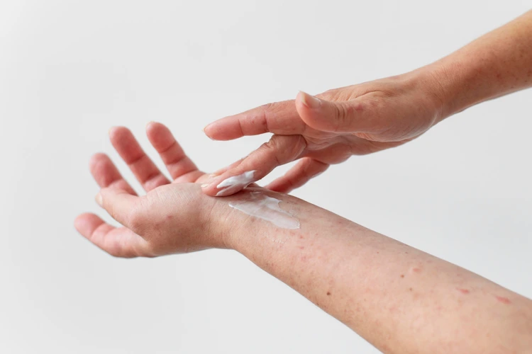 Person suffering from eczema issues applying Eczema Cream on her wrist.