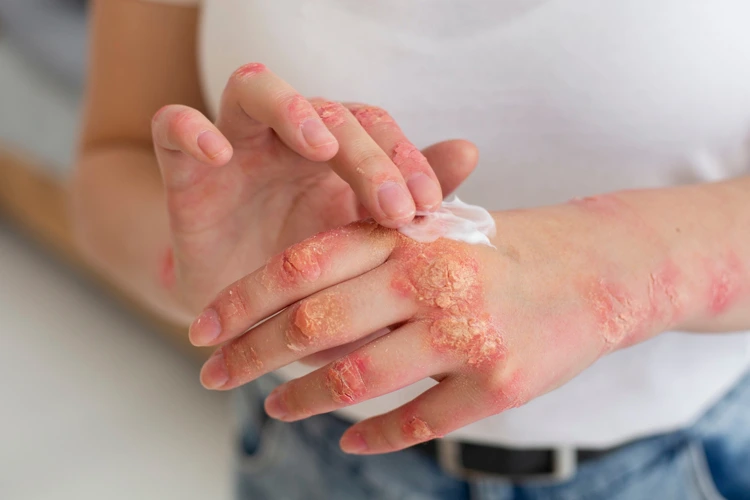 Person suffering from eczema issues applying Eczema Cream on her hand.