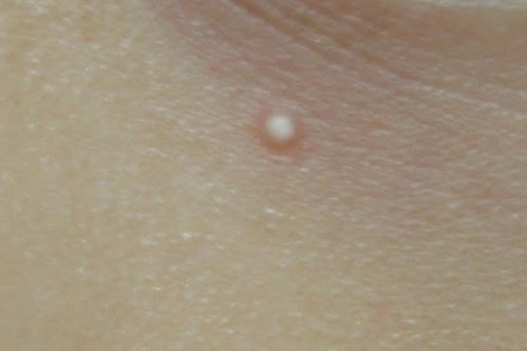 Close up view of milium cyst on person's skin.