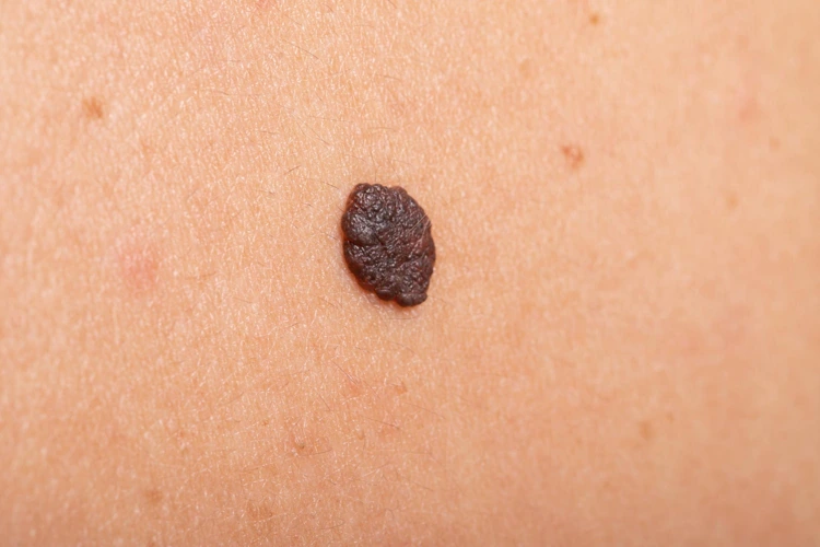 Close up view of mole on patient.