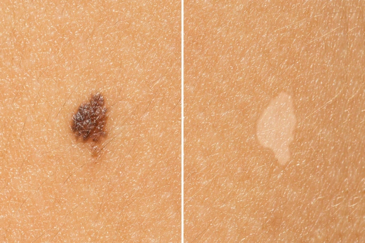 Close up view of before and after mole removal treatment on patient's skin.