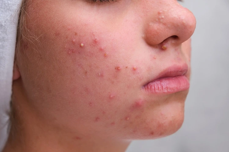 Lady with a severe case of acne breakout on her face.