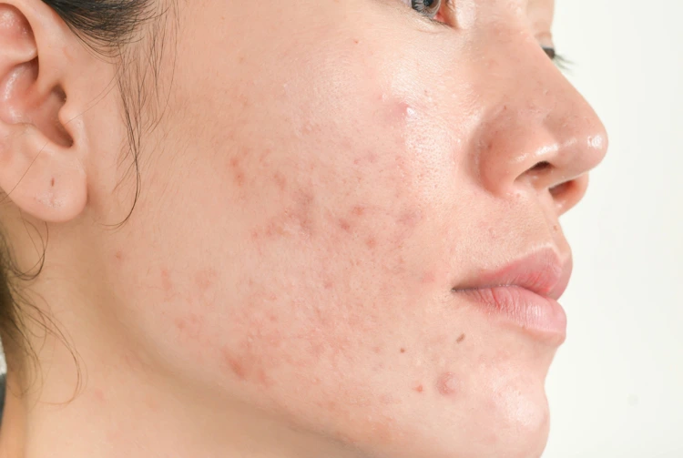 The presence of acne scars on the right side of a lady's face.