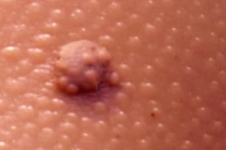 Close up view of skin tag on patient's skin.