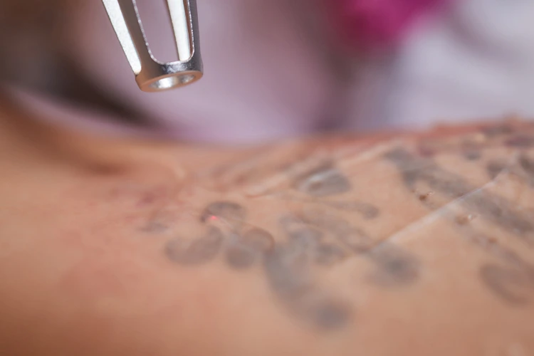 Patient undergoing laser tattoo removal at clinic.