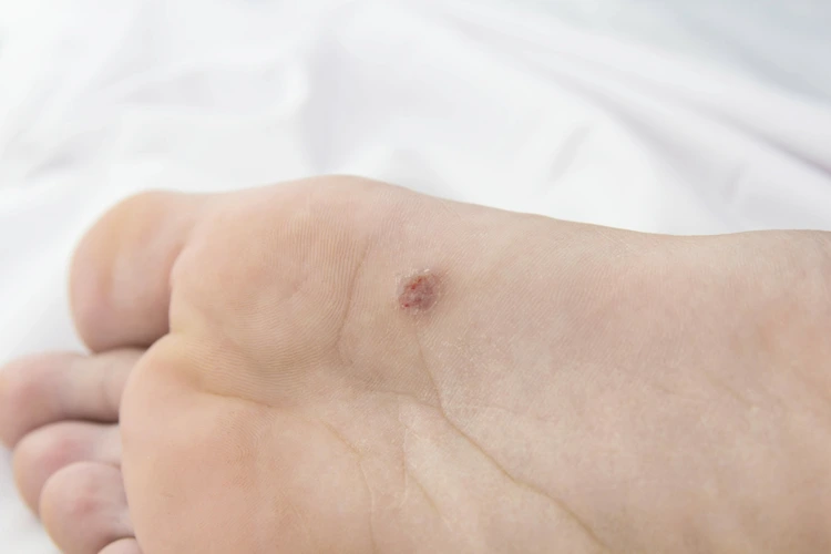 Close up view of the presence of wart on sole.