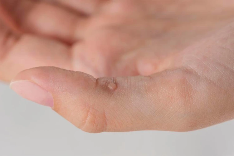Close up view of the presence of wart on person's thumb.